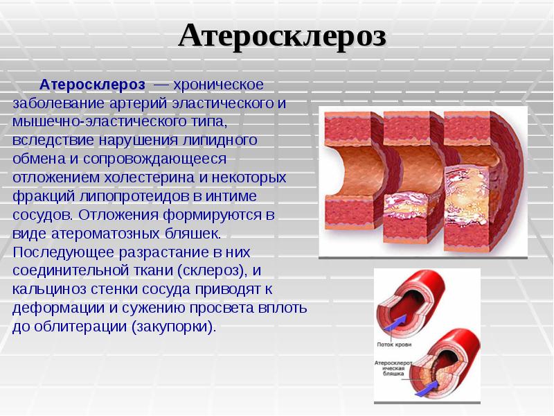 Артериальные заболевания. Атеросклероз заболевание артерий эластического. Нарушение периферического кровообращения. Типовые формы патологии периферического кровообращения. Нарушение периферического кровообращения таблица.