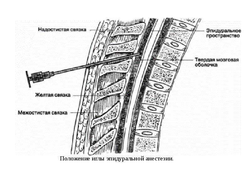 Уровни эпидуральной анестезии. Номограмма эпидуральная анестезия. Эпидуральная анестезия уровень пункции. Эпидуральная анестезия катетер. Эпидуральная анестезия уровни катетеризации.