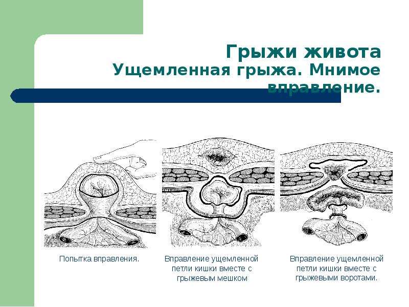 Наружные и внутренние грыжи живота презентация