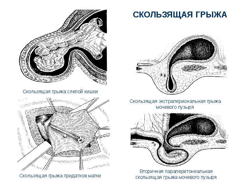 Скользящая грыжа. Этиология скользящей грыжи. Скользящая грыжа передней брюшной стенки. Скользящие паховые грыжи. Клиническая картина скользящей грыжи.