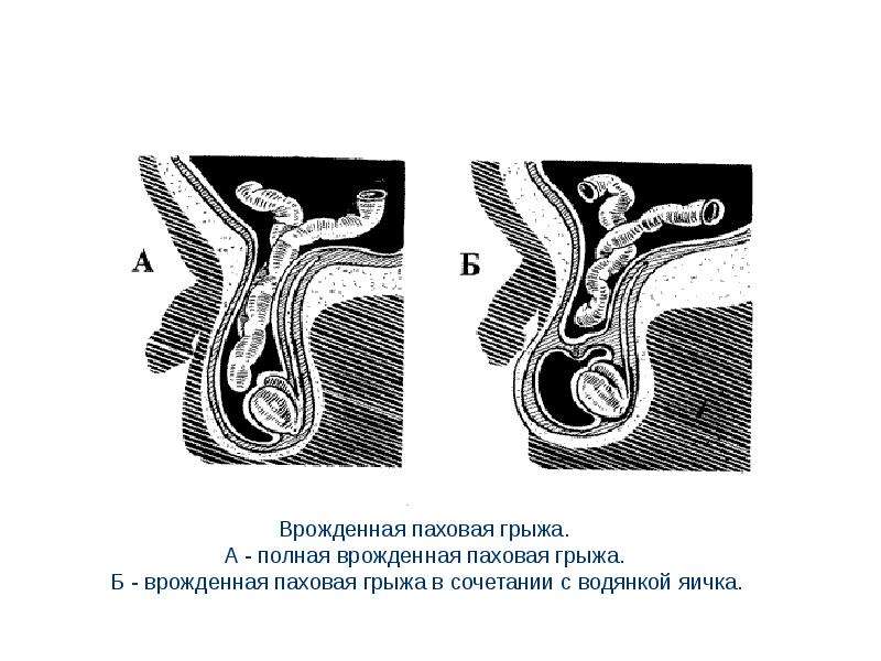 Грыжи живота презентация скачать