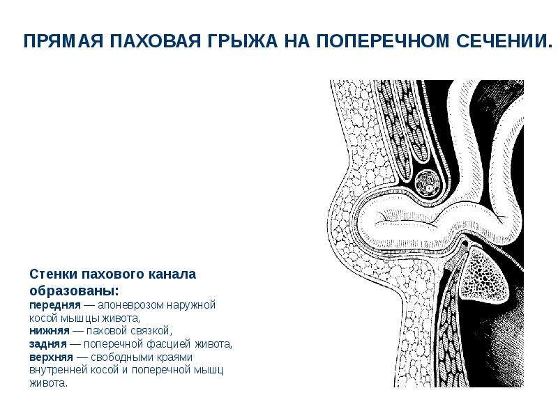 Тейпирование паховой грыжи у мужчин схема