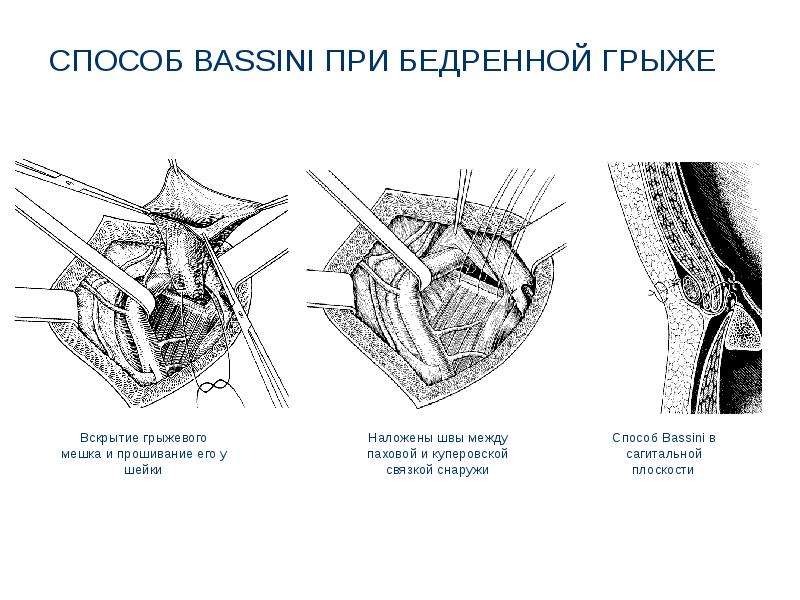 Презентация грыжи живота хирургия