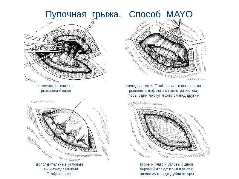 Грыжи живота презентация скачать