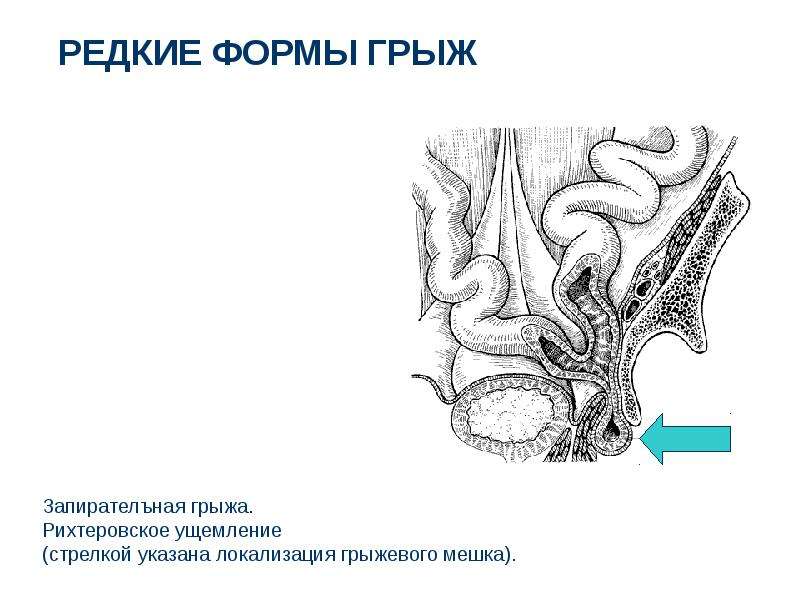 Грыжи живота презентация скачать