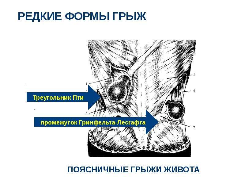 Грыжи живота презентация скачать