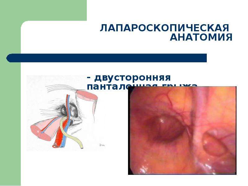 Грыжи живота презентация скачать