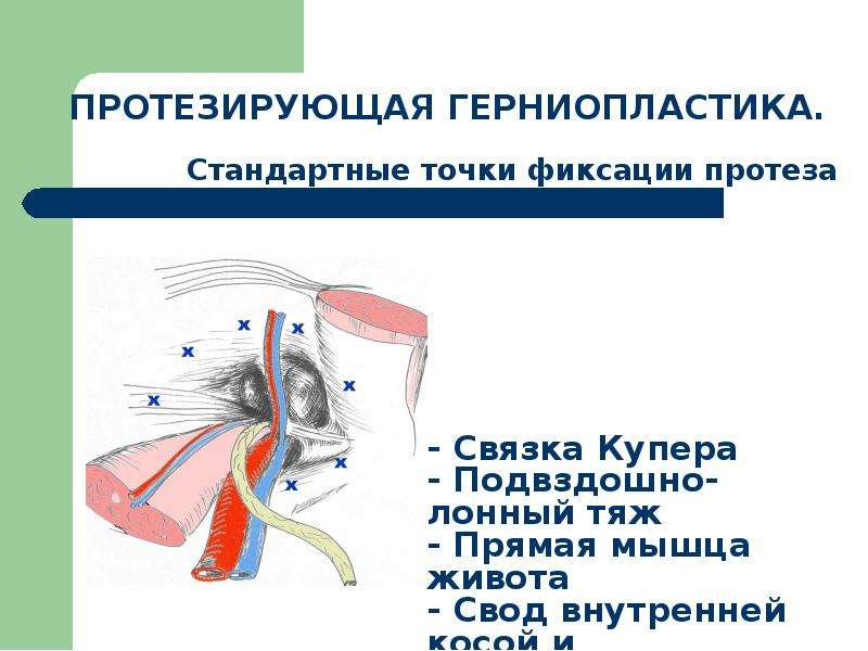 Наружные и внутренние грыжи живота презентация