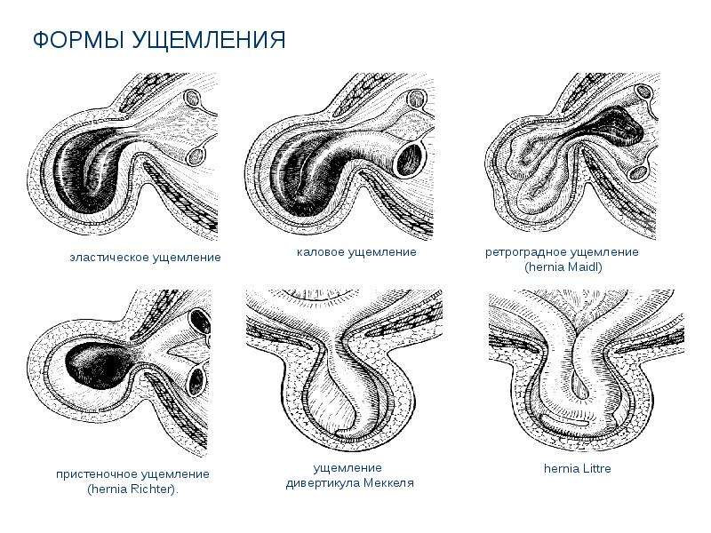 Грыжи живота презентация скачать