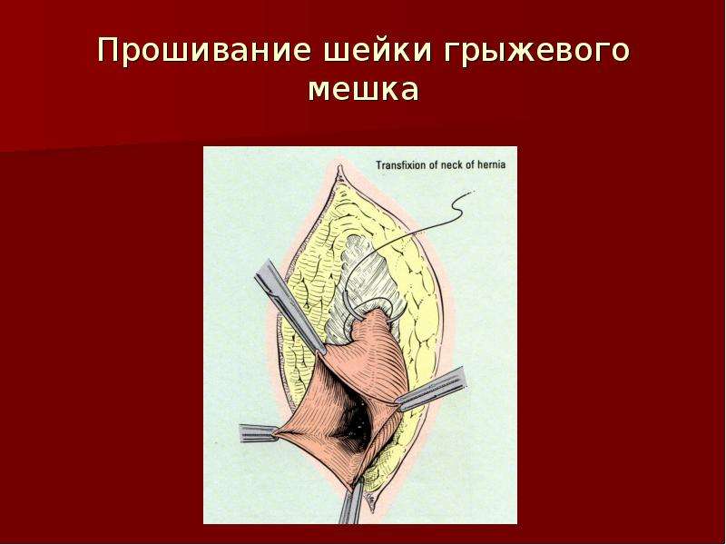 Осложнения грыж. Осложнения грыж презентация. Осложнения грыжевого мешка.