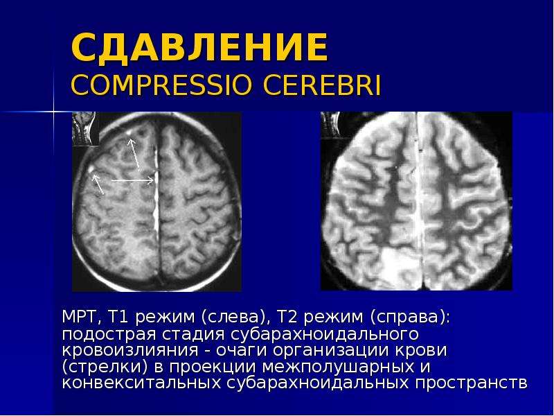 Мр картина неравномерного расширения субарахноидальных конвекситальных пространств