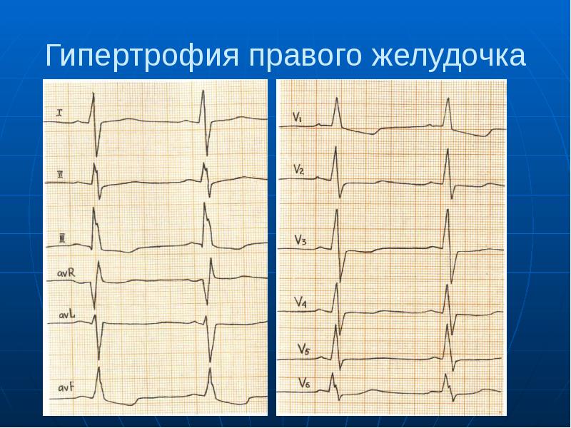 Ниже представлена фотография фрагмента электрокардиограммы и увеличенный снимок одного из сердечных