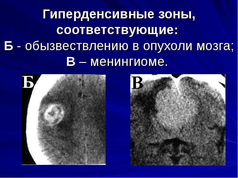 В серошкальном изображении гиперденсный участок