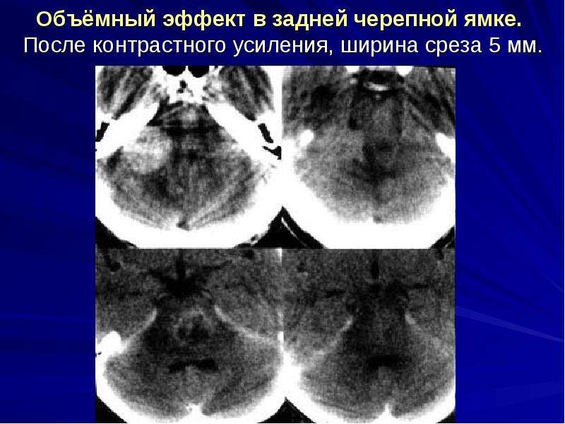 После контраста. Декомпрессия задней черепной ямки. Операция декомпрессия задней черепной ямки. Сжавление опухолью в зажней черепной ямке. Кт декомпрессии задней черепной ямки.