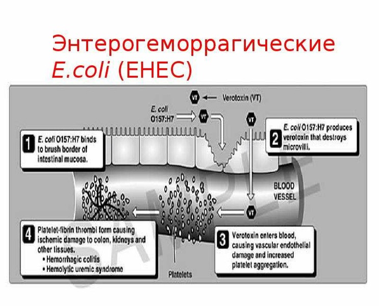 Схема патогенеза эшерихиоза