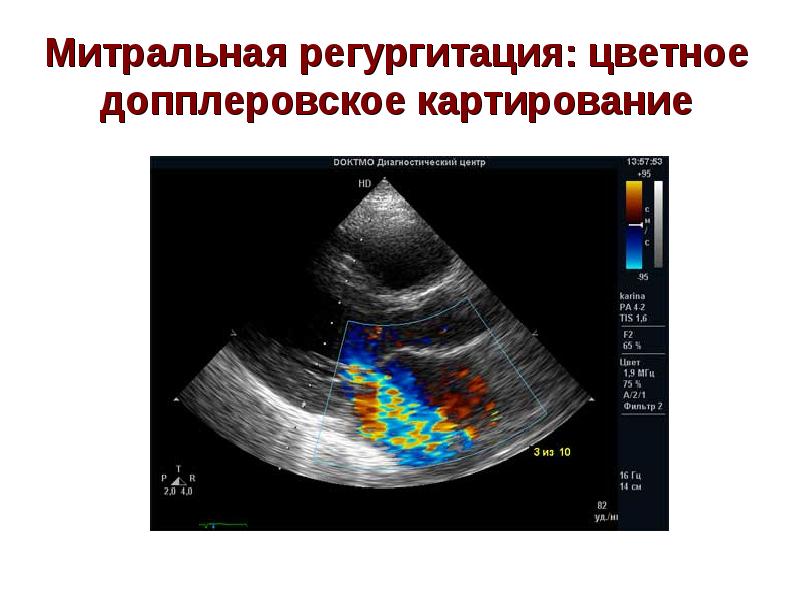 Пролапс митрального клапана с регургитацией 2