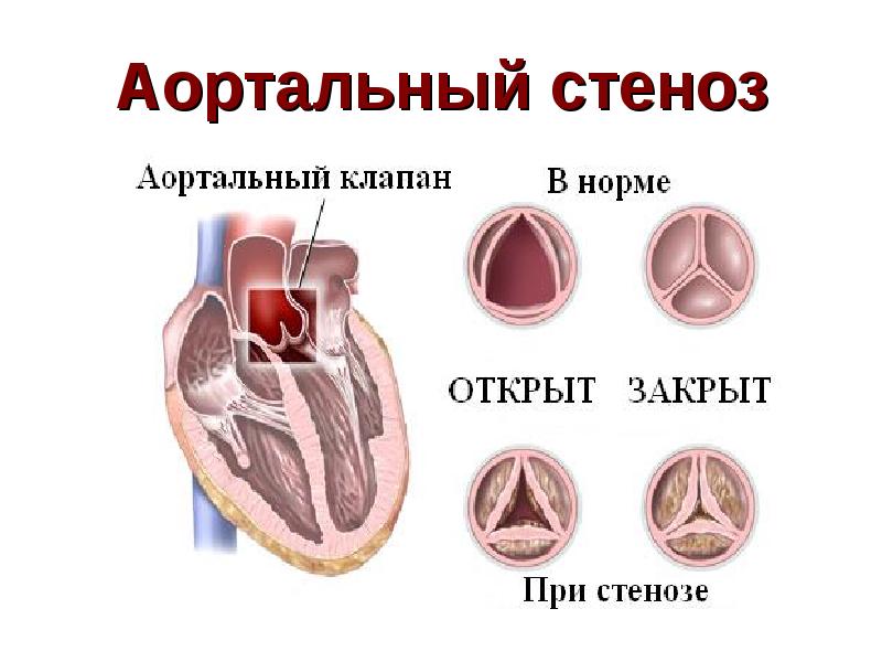 Аортальный клапан картинка