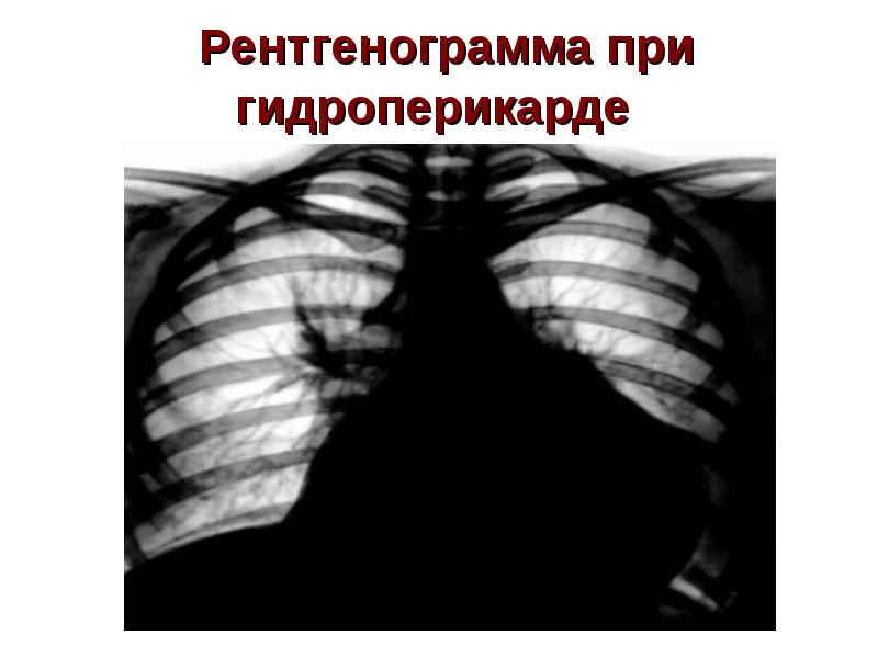 Гидроперикард. Гидроперикард рентгенография. Гидроперикард на рентгенограмме. Гидроперикард симптомы.