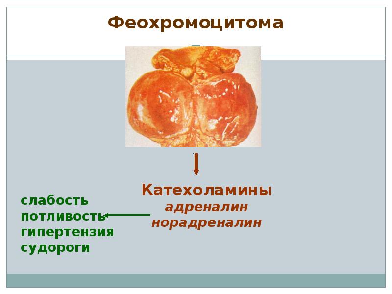 Феохромоцитома фото больных