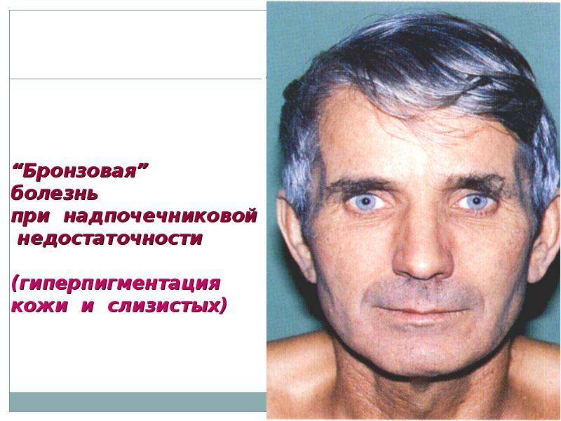 Болезни 9. Бронзовая болезнь причины. Гиперпигментация кожи при надпочечниковой недостаточности. Бронзовая болезнь симптомы.