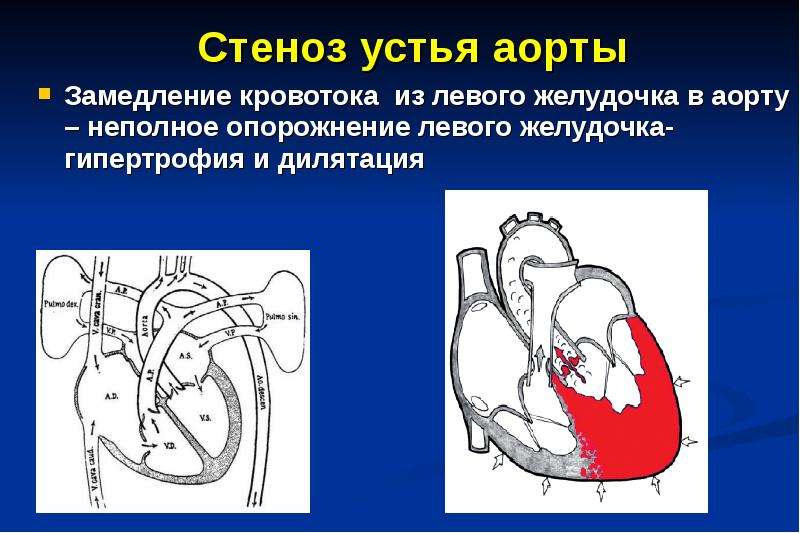 Стеноз аорты у детей презентация