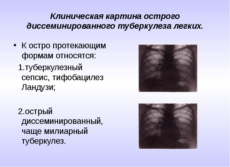 Туберкулез легких клиническая картина