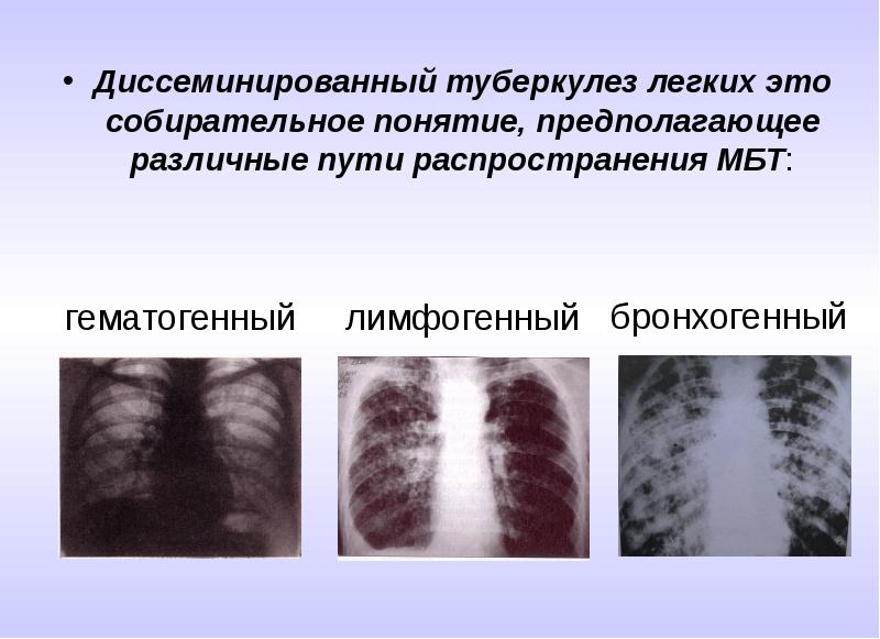 Диссеминированный туберкулез легких картинки