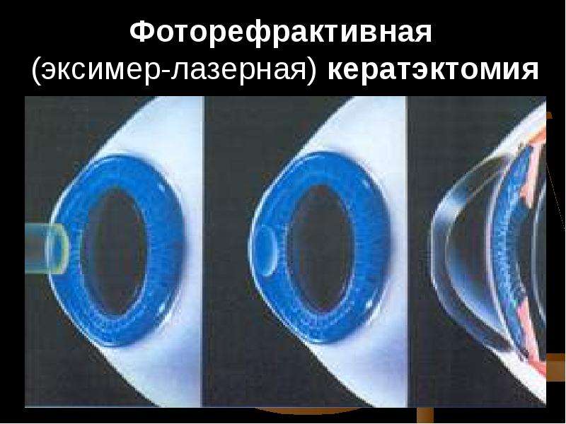 Зрение 2 операция. Фоторефракционная кератэктомия (ФРК). Лазерная коррекция зрения методом ФРК. Эксимер-лазерная операция ФРК. Эксимерлазерная кератэктомия.