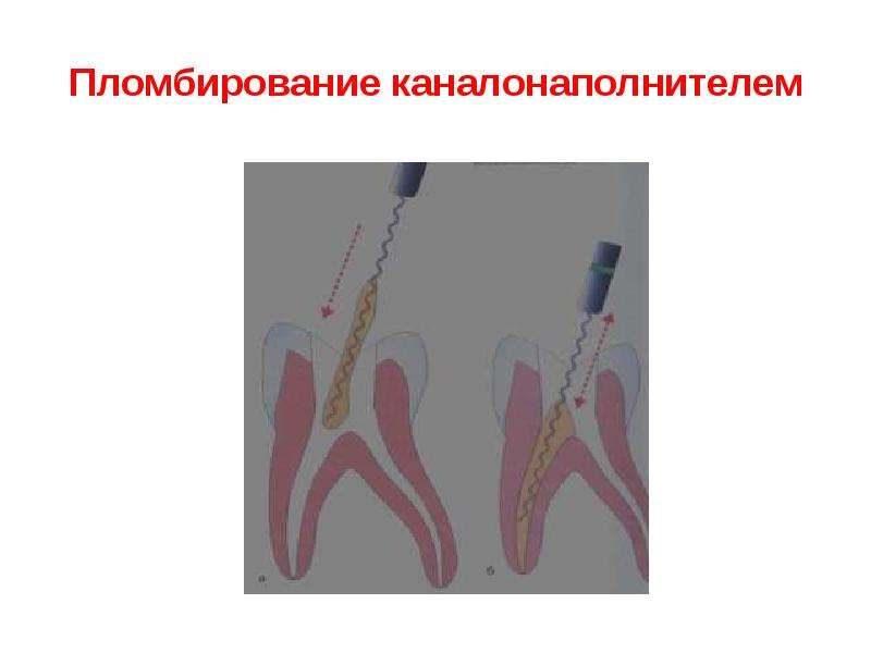 Пломбирование каналов презентация