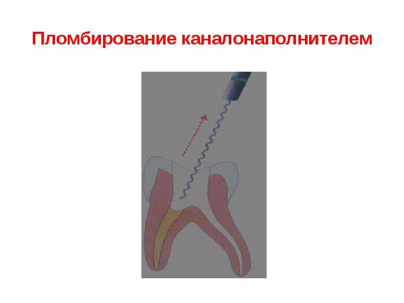 Пломбирование каналов презентация