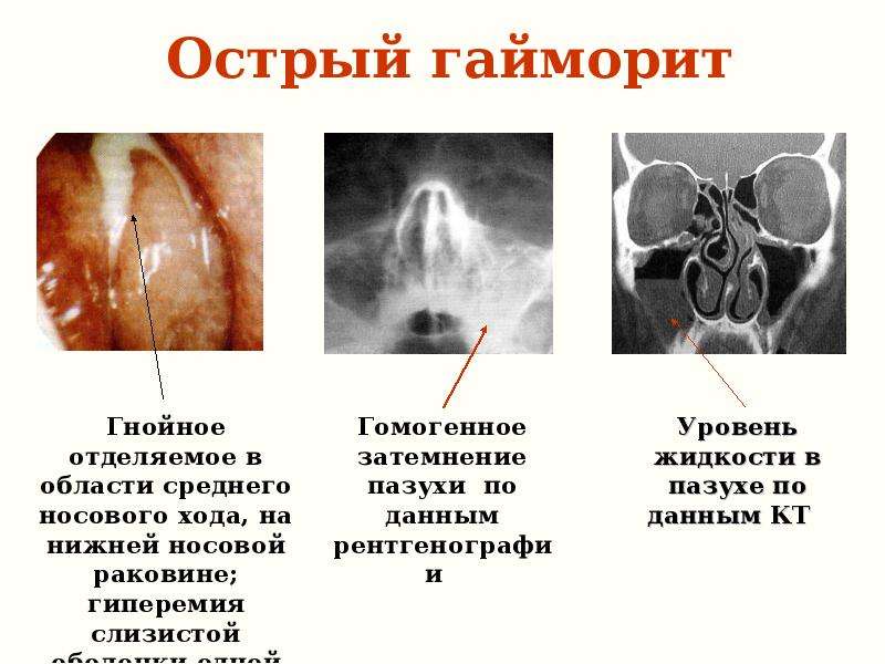 Презентация заболевания носа и околоносовых пазух