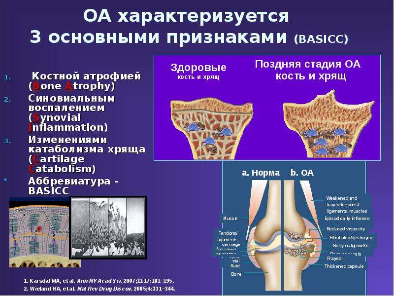 Патогенез остеоартроза презентация