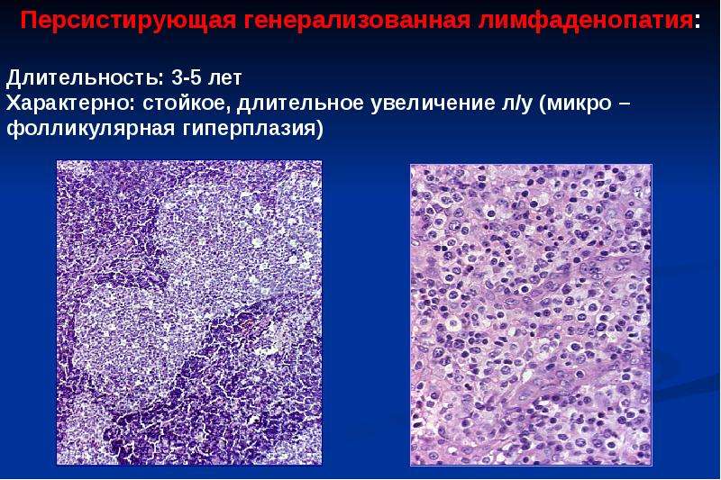 Фиброинтимальная гиперплазия стенки бца