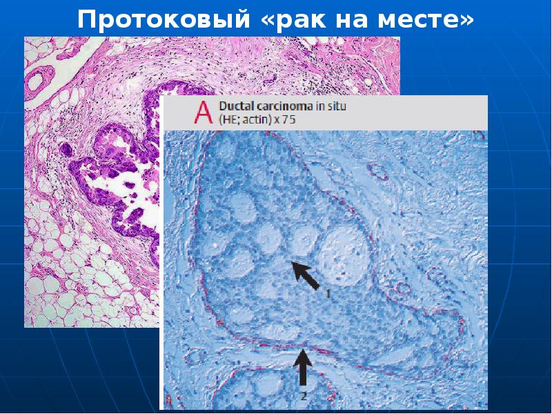 Протоковая карцинома in situ молочной. Протоковый «рак на месте». Расширение протоковой системы придатков.