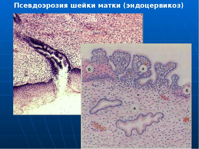 Что такое эндоцервикоз. Эндоцервикоз микропрепарат патанатомия. Железистая псевдоэрозия шейки матки микропрепарат. Эндоцервикоз шейки матки микропрепарат. Эндоцервикоз микропрепарат.