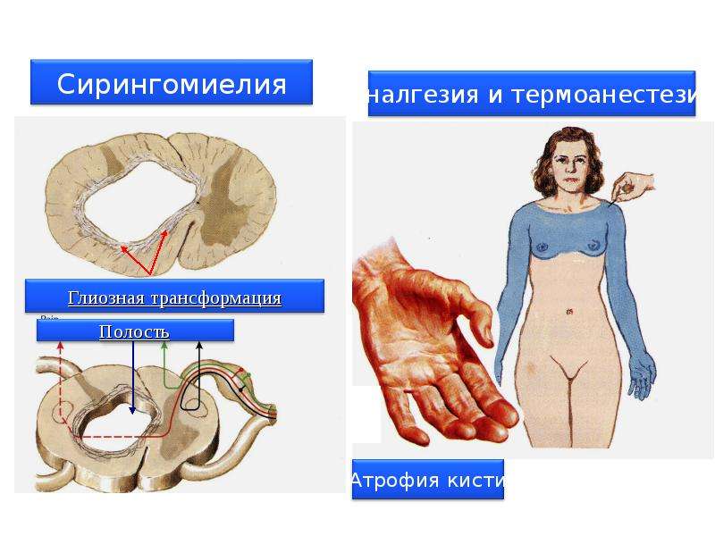 Сирингомиелия презентация по неврологии