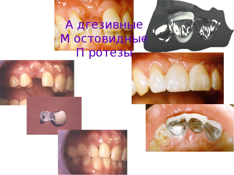 Адгезивные мостовидные протезы презентация