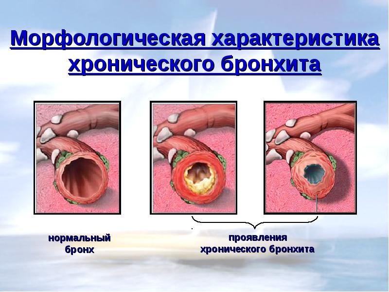 Хронический бронхит картинки для презентации