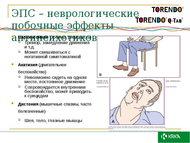 Тремор головы при волнении