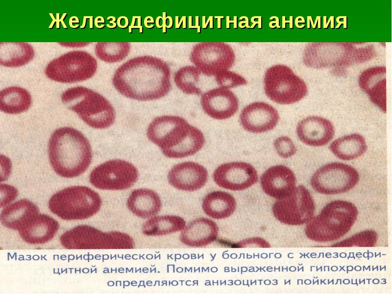 Картина периферической крови при железодефицитной анемии