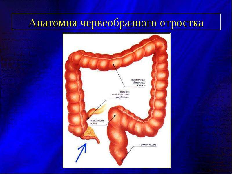 Что такое аппендицит картинки