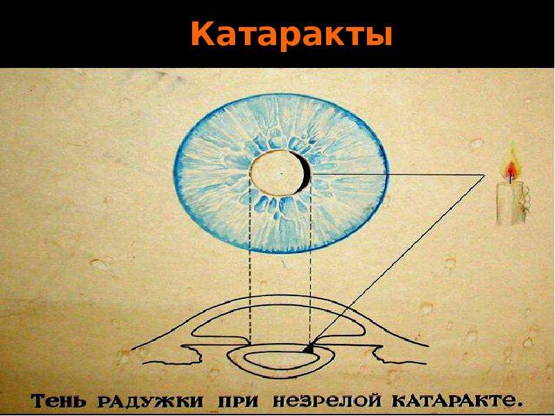 Хрусталик формирует на сетчатке реальное изображение