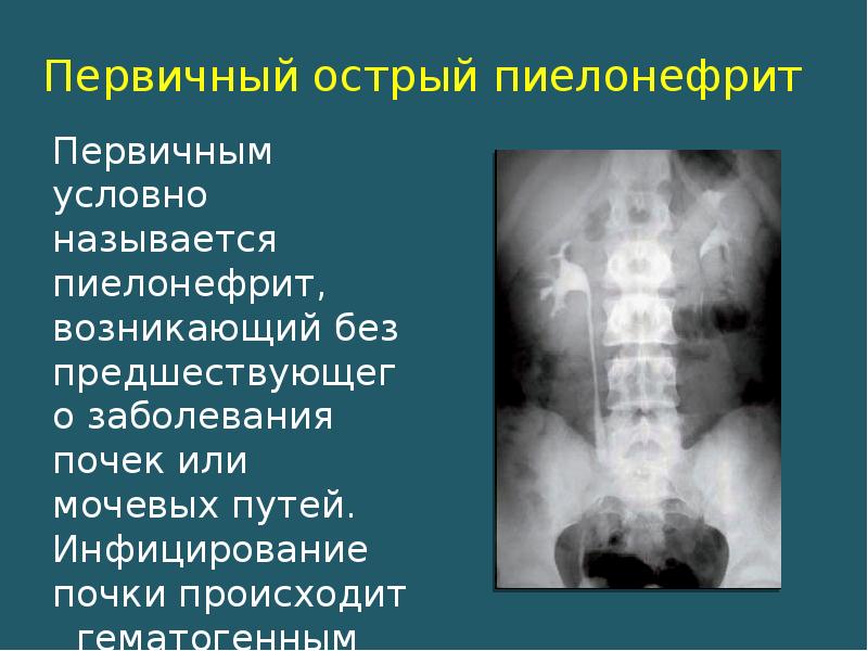 Карта острый пиелонефрит