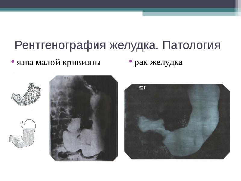 Рентгенография желудка презентация