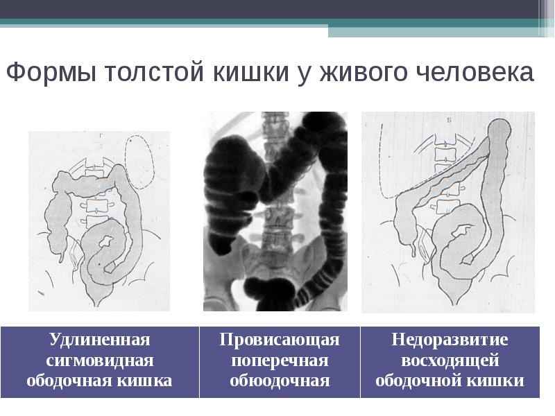 Трансверзоптоз кишечника. Долихосигма кишечника петля. Дополнительная петля сигмовидной кишки рентген. Толстая кишка долихосигма. Удлинённая петля сигмовидной кишки.