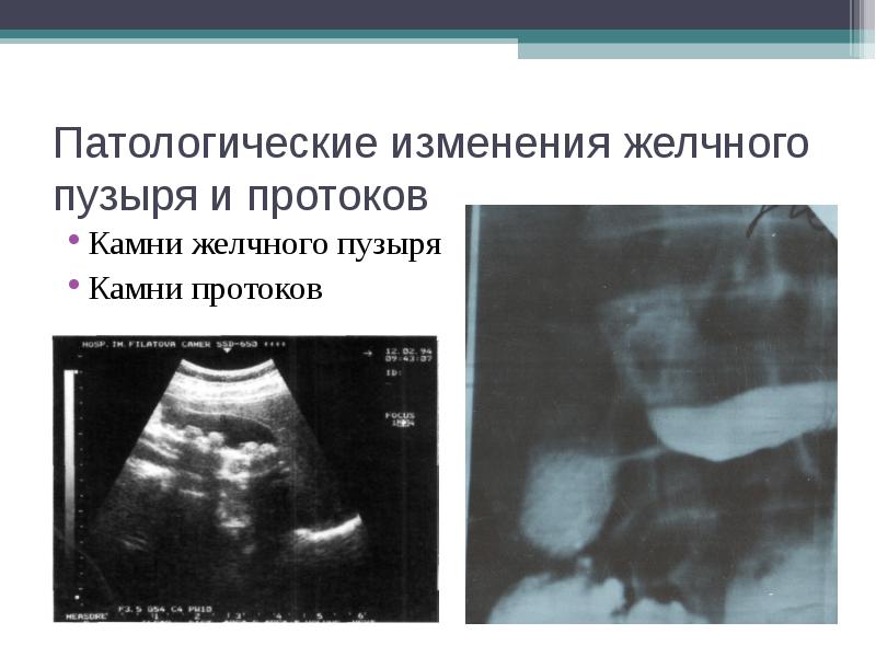 Диффузные изменения структуры стенок желчных протоков