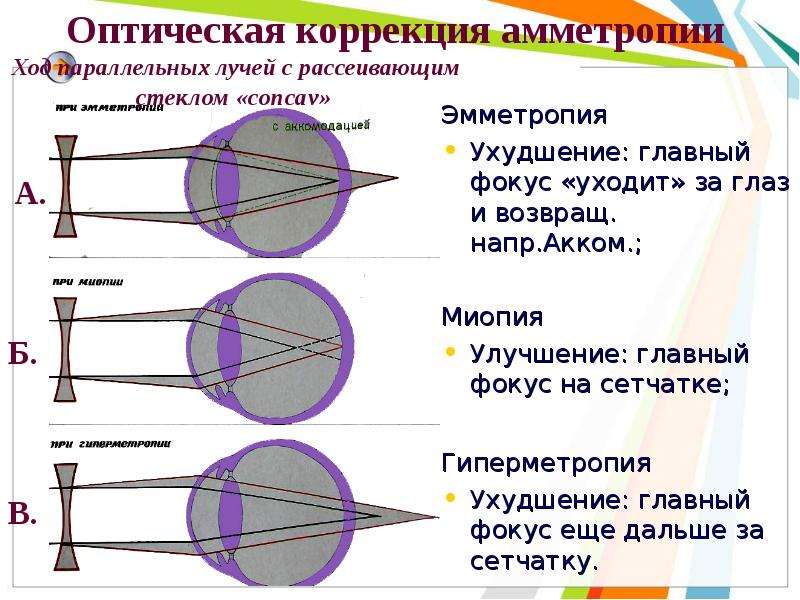 Презентация про близорукость