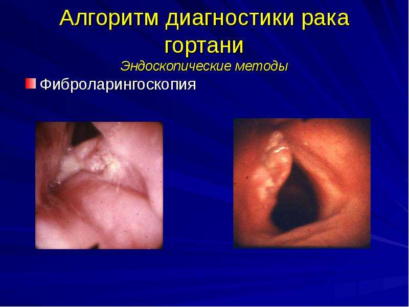   Алгоритм диагностики рака гортани
Эндоскопические методы
Фиброларингоскопия
