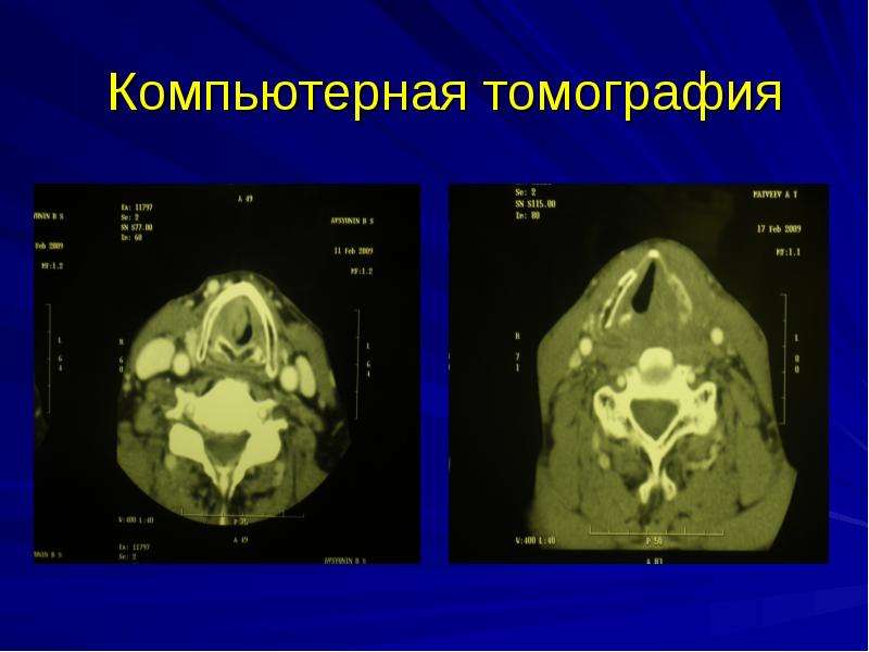   Компьютерная томография
