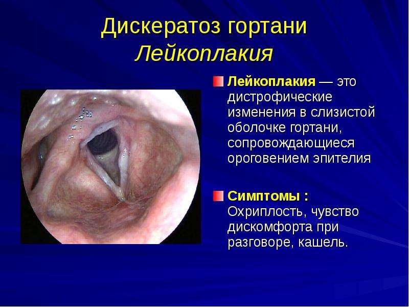   Дискератоз гортани
Лейкоплакия
Лейкоплакия — это дистрофические изменения в слизистой оболочке гортани, сопровождающиеся ороговением эпителия
Симптомы : Охриплость, чувство дискомфорта при разговоре, кашель.
